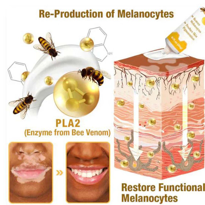 MD Vitigo™ Advanced Vitiligo Restore Cream ✨ | Buy 1 Get 1 Free 🔥